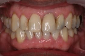前歯部オールセラミックス＋ダイレクトボンディング02治療前