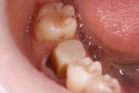 下顎臼歯部オールセラミックス01治療前