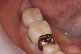 下顎臼歯部オールセラミックス02治療後