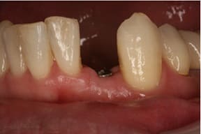 前歯部インプラント02治療前