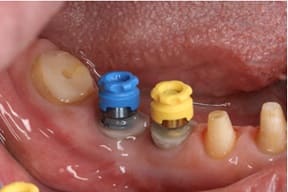 臼歯部インプラント01治療前