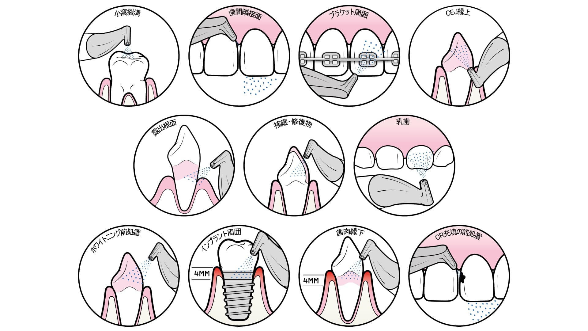 GBT（Guided Biofilm Therapy）療法